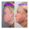 Facial Rejuvenation Device - 7 LED, RF, EMS, Sonic Vibration, Hot Massage THERAPY