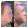 Facial Rejuvenation Device - 7 LED, RF, EMS, Sonic Vibration, Hot Massage THERAPY